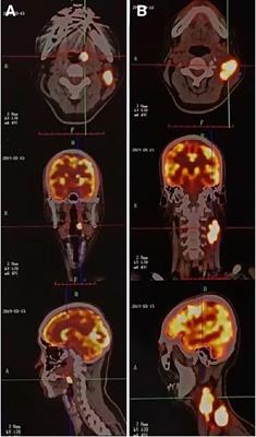 Response of Tonsil Follicular Dendritic Cell Sarcoma to Multimodal Treatment Including Pembrolizumab: A Case Report and Literature Review